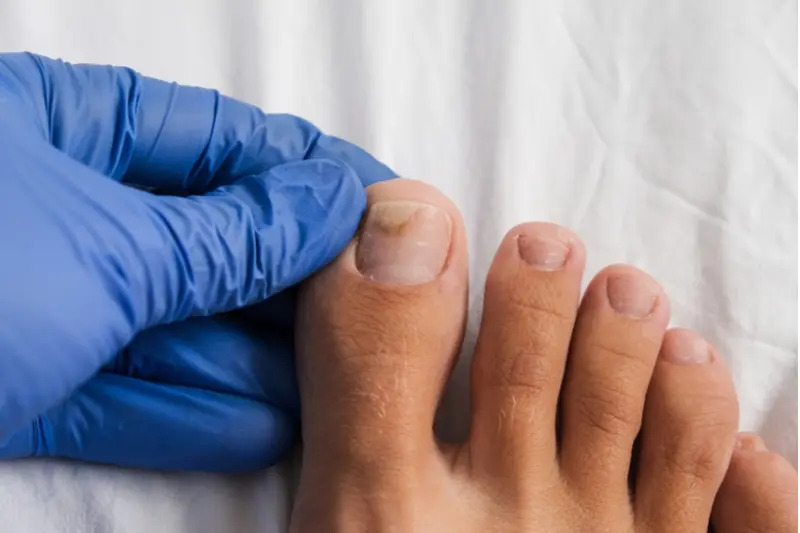 Fungal Nail Infections | Sole Body Soul