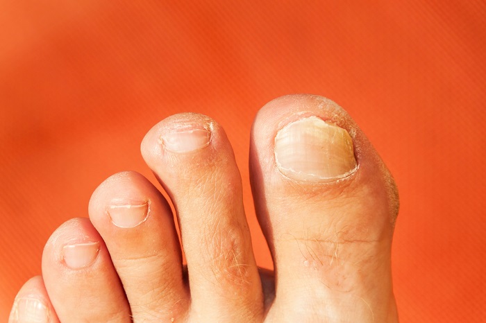 Thickened toe nails