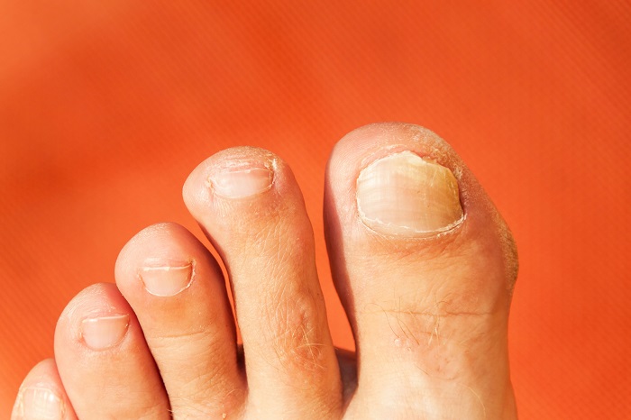 What Are The Causes of Thick Toenails?