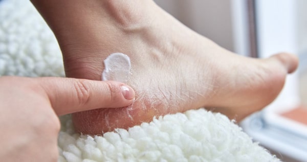 Cracked Heels: Remedies, Prevention, and More
