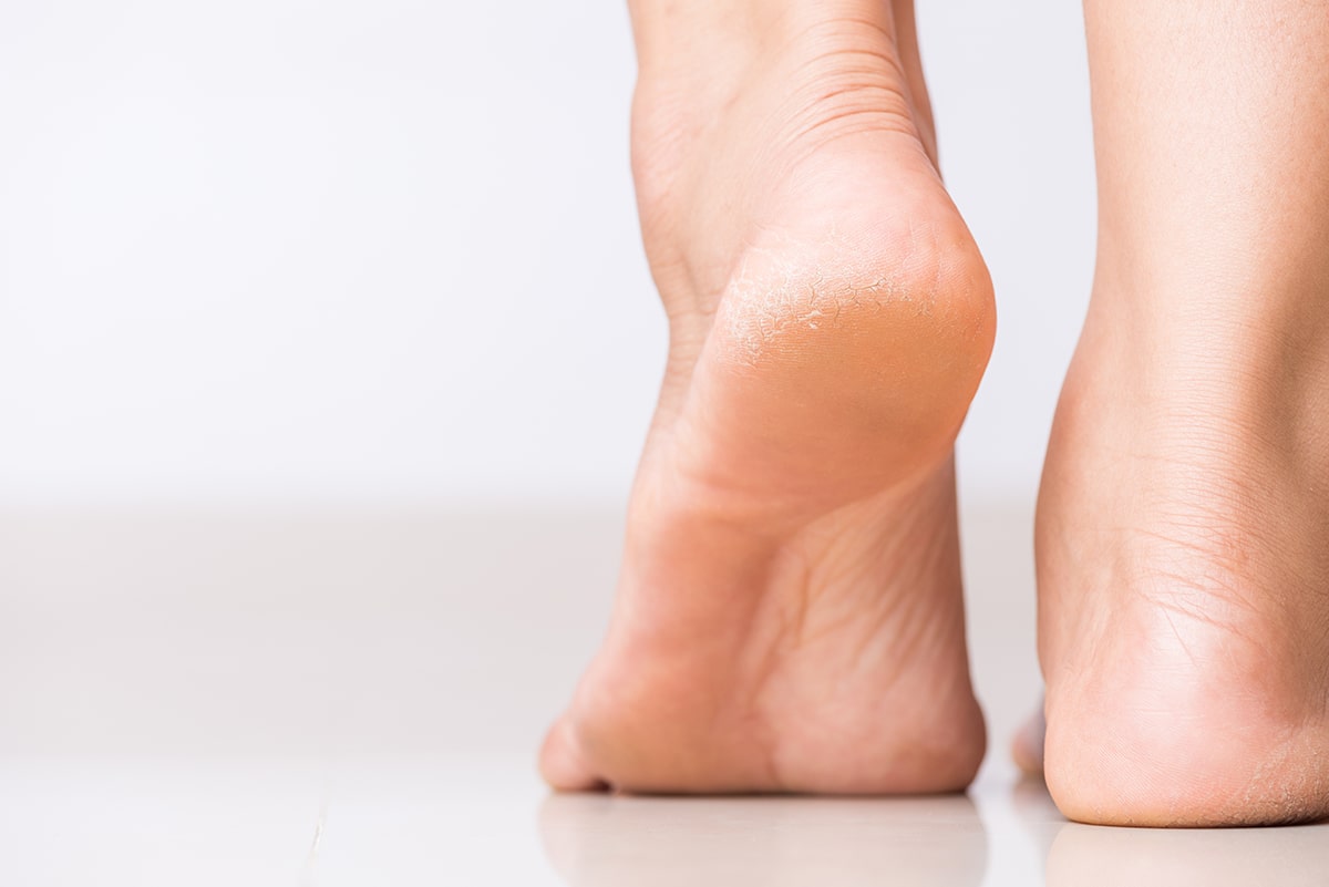 Woman with dry cracked heels