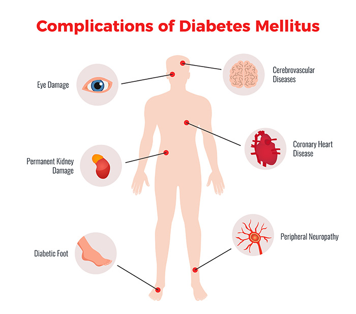 Diagram showing the medical complications of Diabetes.